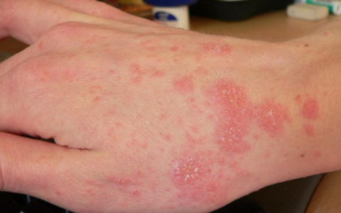 Pelle sensibile? Non è un problema estetico ma immunitario: ecco come riportarla in equilibrio